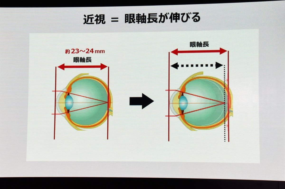 JINSが近視進行を抑制するメガネ型医療機器の開発に着手 いま