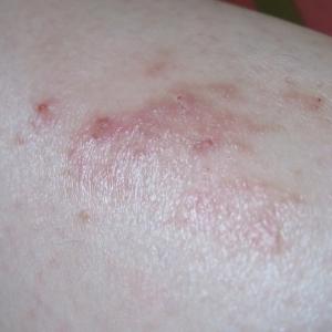 注意 あなたの布団にダニはどれほどいる 実際に刺されたので対策に乗り出してみた ガジェット通信 Getnews